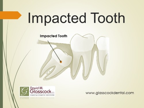 Impacted Tooth- Glasscock Dental